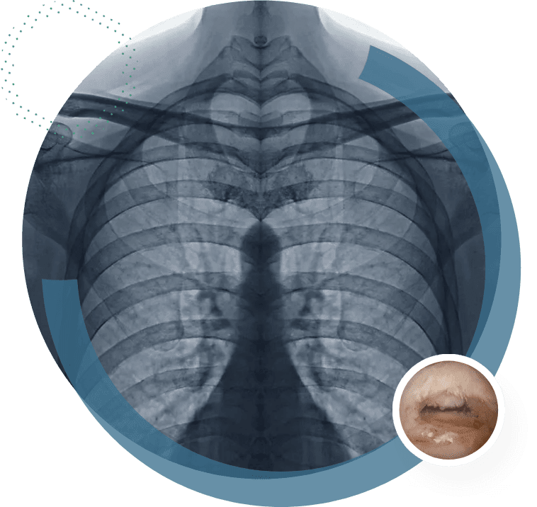 X-ray Medical radiography thorax