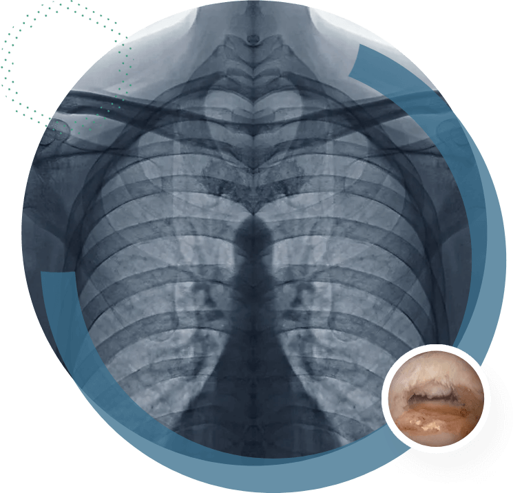 X-ray Medical radiography thorax