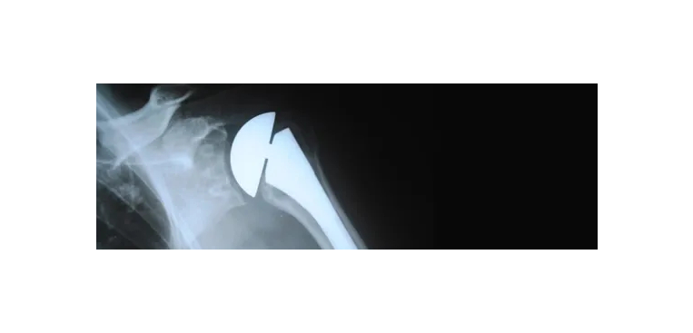 X-ray of a Bone